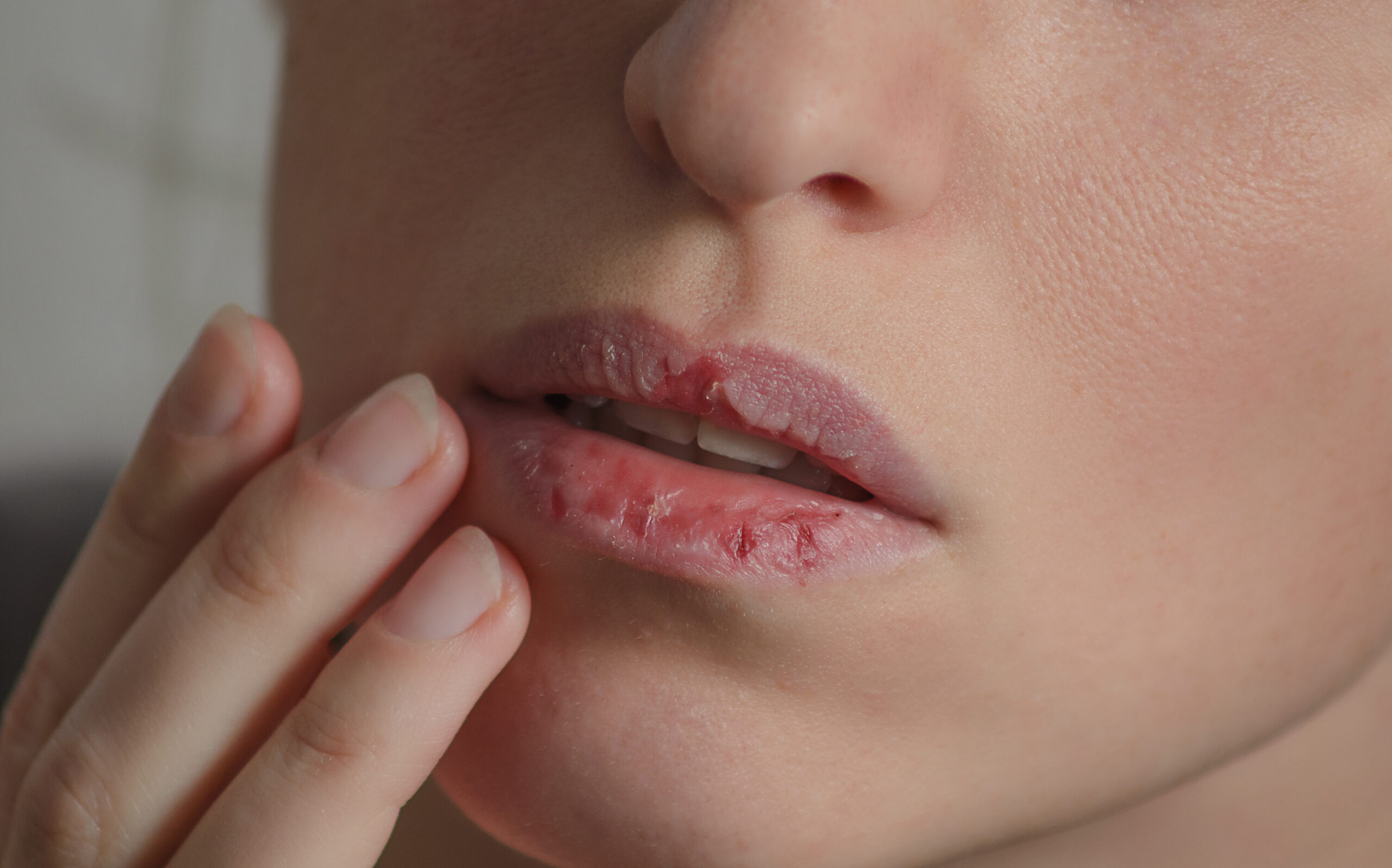 Chapped Lips While it may seem that dry, cracked lips are something you mus...